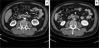 Management of retroperitoneal fibrosis with endovascular aneurysm repair in patients refractory to medical management